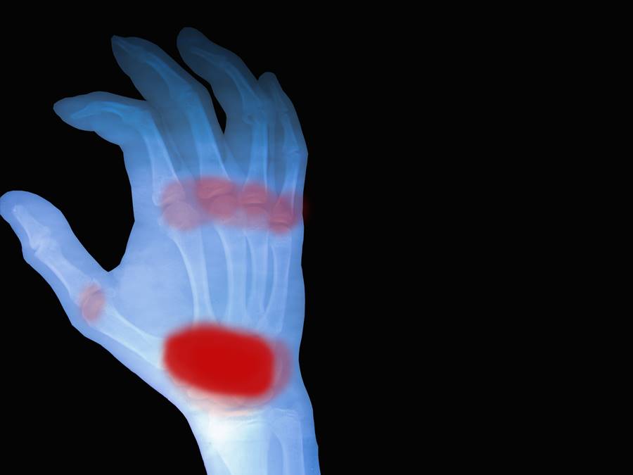 semne de artrită reumatoidă a gleznei ieșirea articulației genunchiului
