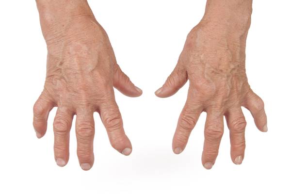 umflarea cu artrita mâinilor)
