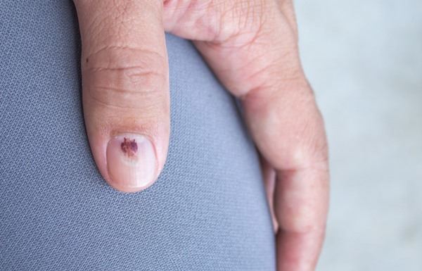 Pielea și unghiile – cum sunt afectate de tratamentul oncologic, Cancer la unghie