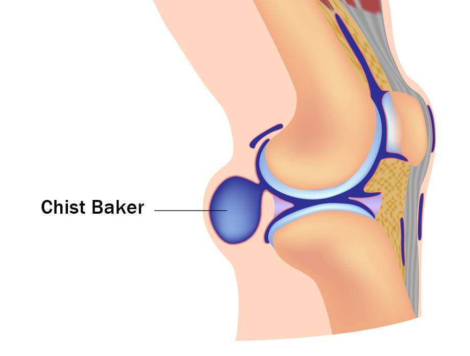 lichid sub tratamentul articulației genunchiului