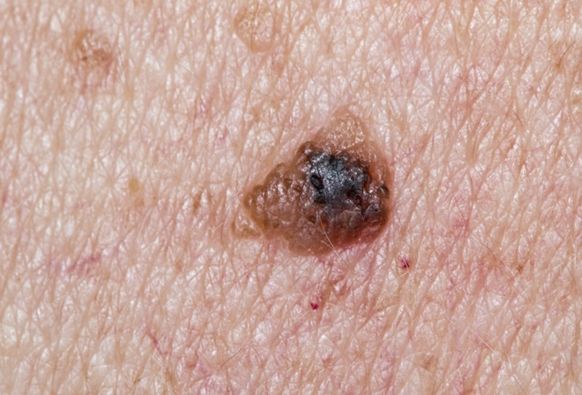 cancer de piele durata de viata