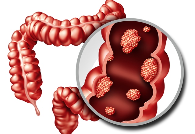 Durere în intestine înainte de mișcarea intestinului - Ulcere 