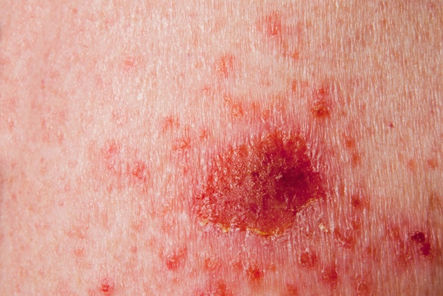 cancer de piele incipient