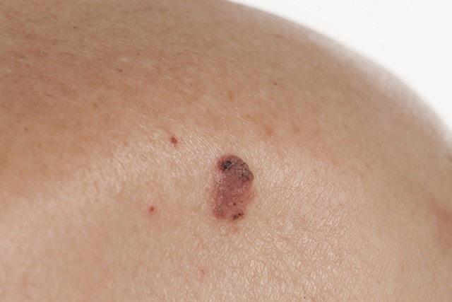 Semne ale Cancerului de piele