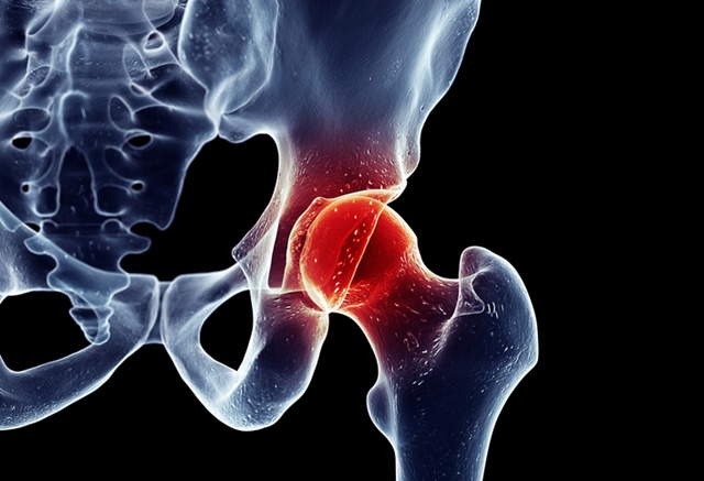 care sunt durerile osteoporozei articulației șoldului)