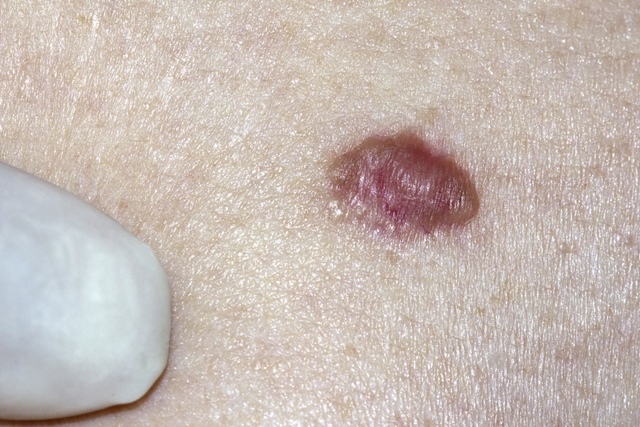 cancerul de piele bazocelular
