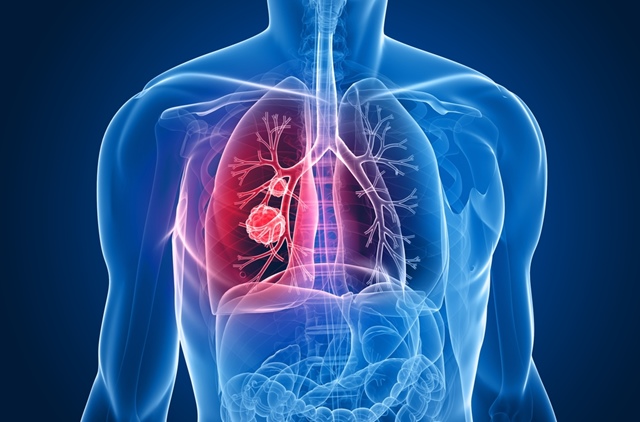 Speranta de viata la pacientii cu cancer pulmonar