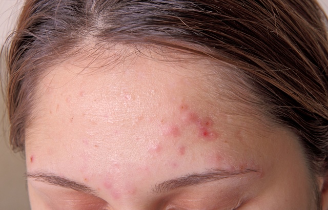 simptome de acnee)