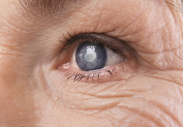 După picături din cataractă, vederea s-a deteriorat