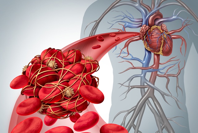 9 tratamente naturale pentru subtierea sangelui si prevenirea cheagurilor (tromboza)