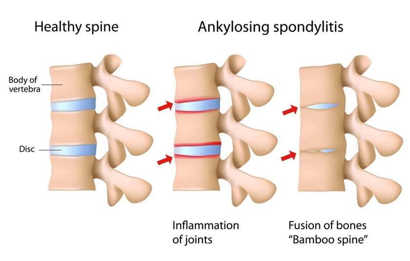 spondilita simptome durere în apropierea omoplatului stâng mai aproape de coloana vertebrală