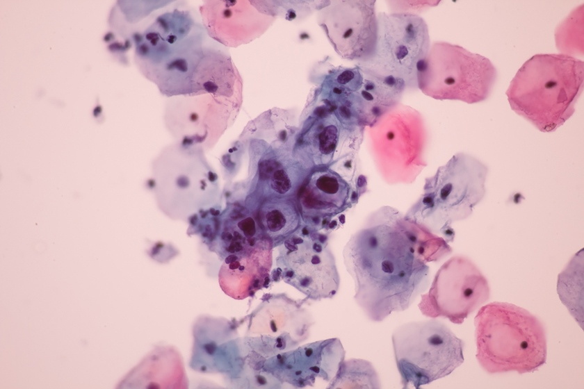 Virusul Papiloma - potenţială cauză în cazul neoplasmelor orofaringian și laringian