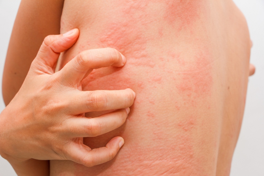 Care tratează artrita alergică - Afectarea pulmonară în cadrul bolilor de sistem