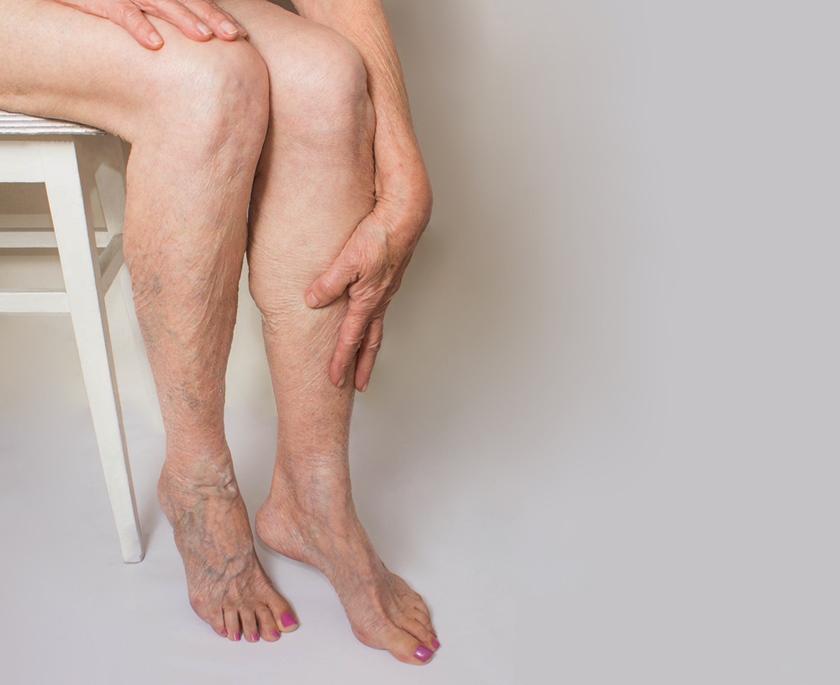 Varicele la picioare: ce sunt, de ce apar și cum le tratăm