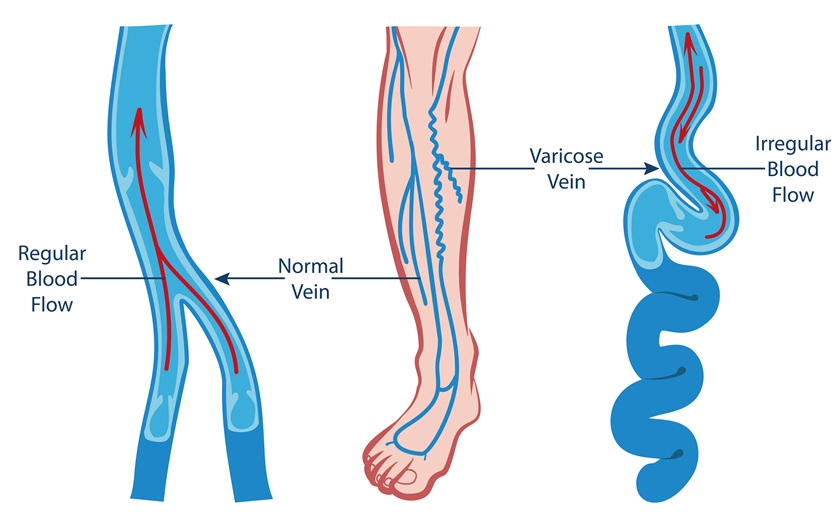 tipuri de venele venelor pe picioare