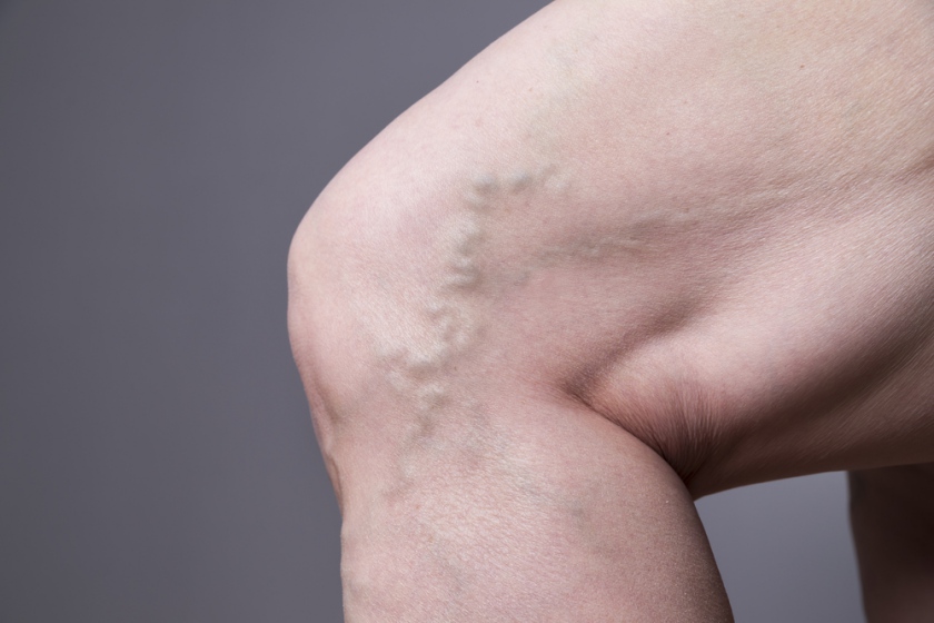 varicosera i durerea în genunchi cu vene varicoase care au contact