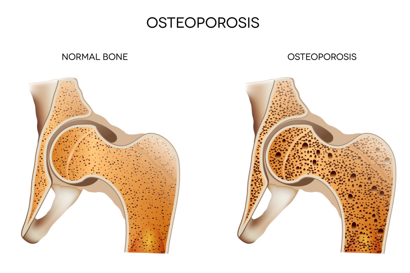 Osteoporoza. Cauze, diagnostic si tratament