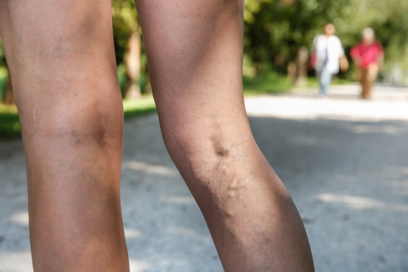 Cauze, simptome și tratamentul varicelor la bărbații de pe picioare - Prevenirea August