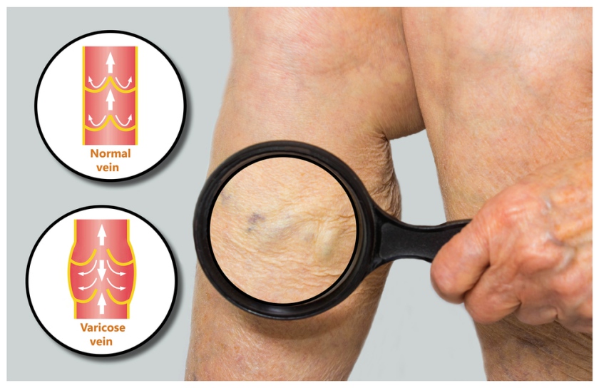 manifestari ale pielii pentru varicitai prevenirea piciorului varicos