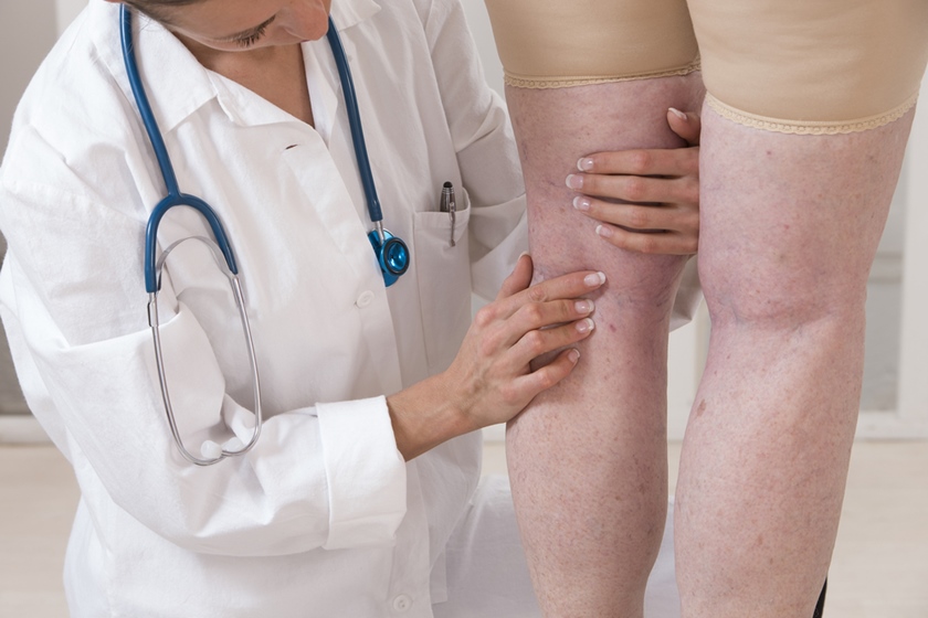 tratamentul eczemei pe picioare în varicoza