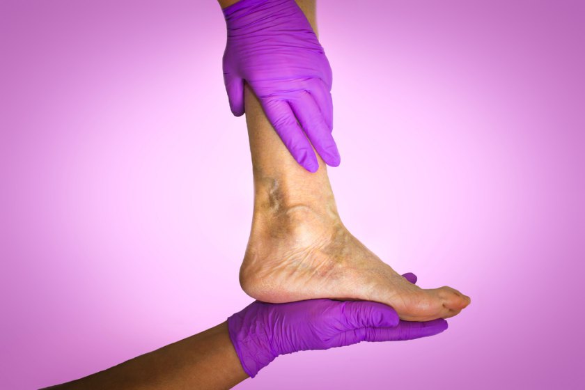 eczema pe picioare în tratamentul venelor varicoase