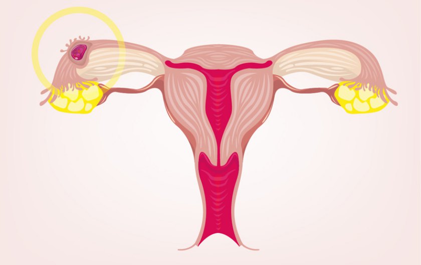 varicoza cavitaii abdominale în timpul sarcinii
