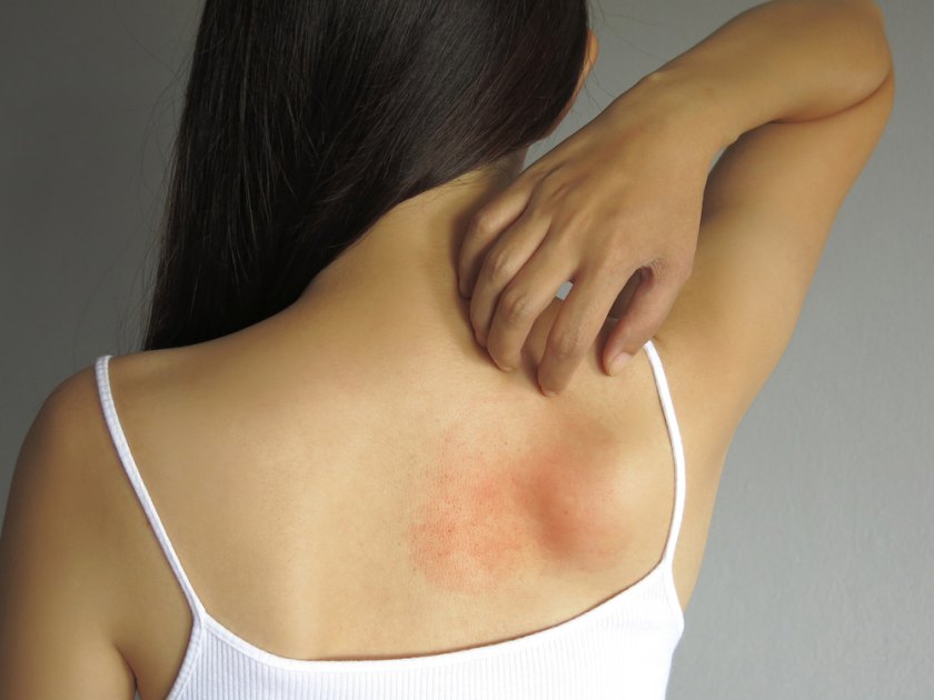 umflarea articulației cu alergii
