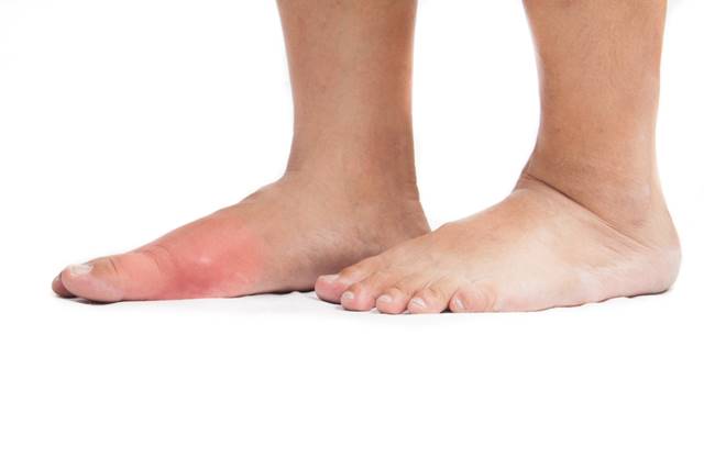 artrita guta a genunchiului