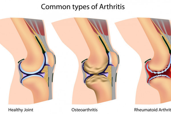 artrita sinovita a genunchiului
