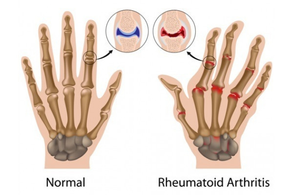 revărsare articulară în artrita reumatoidă)
