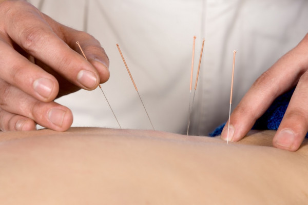 cum ajută acupunctura la durerea articulară