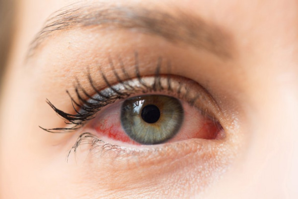 iritatie ochi tratament
