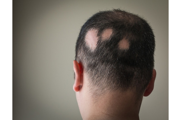 tratamentul paraziților cu alopecie)