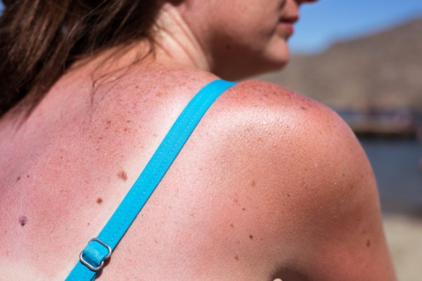 cum să scapi de daunele solare image îngrijirea pielii anti îmbătrânire hidratantă