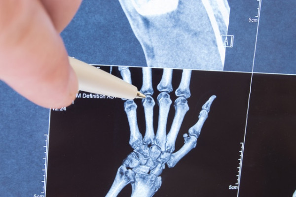 Artroza mainilor: de ce apare si cum se trateaza, Artrita la degetele de la picioare