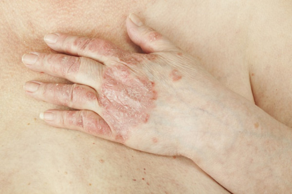 cum se tratează artrita reumatoidă seropozitivă
