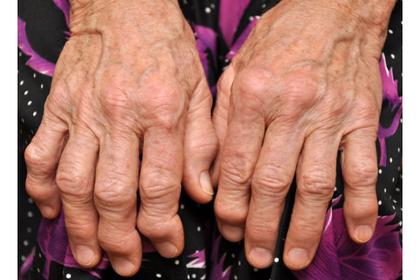 artroza articulațiilor falangale ale mâinilor
