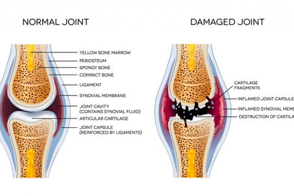 cum se tratează artroza deformantă a articulației șoldului tratamentul articulațiilor țesutului conjunctiv