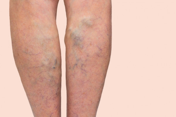 varicose stil de viaa este simptomele picioarelor varicoase la femei