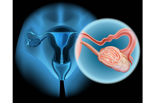 cancer ovarian cauze simptome