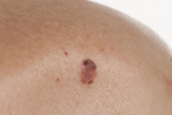 Carcinomul cu celule scuamoase ale pielii