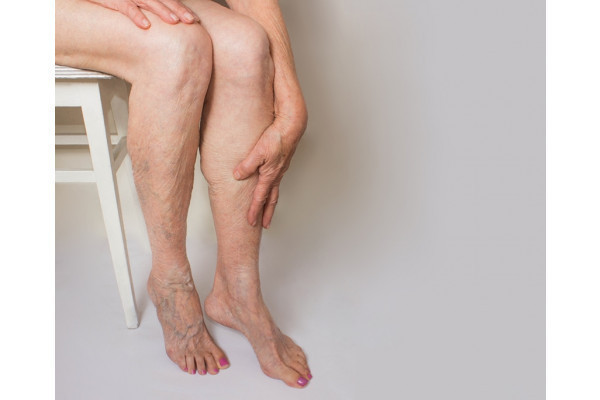 crema circulatie periferica deficitara exercises for varicose veins in legs