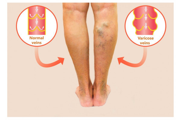 tromboza i venele varicoase ce diferena cum sa vindeci piciorul varicos