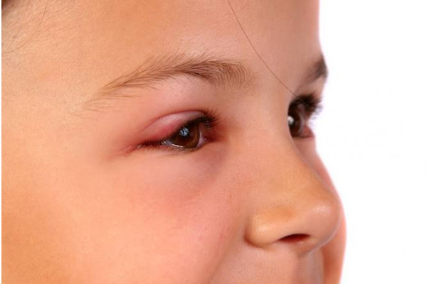 infectii la ochi viziune ambliopică