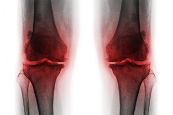eliminați edemul cu artroza articulației genunchiului