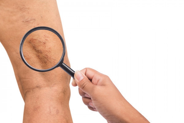 Efectul varicelor asupra corpului poate fi atenuat cu ajutorul unor ciorapi medicinali varice !