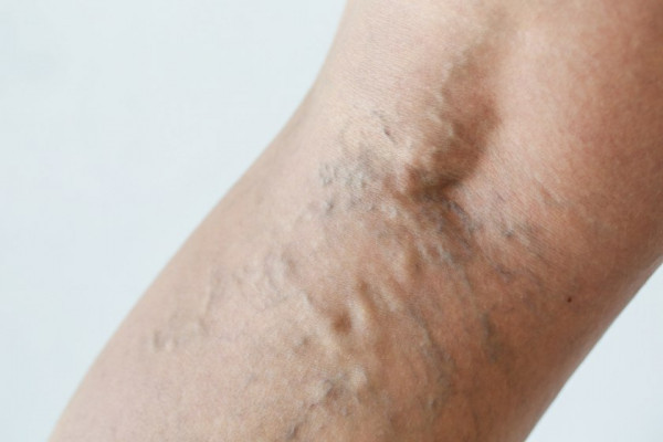 Afirmație cu vene varicoase - De ce sunt venele din picioare