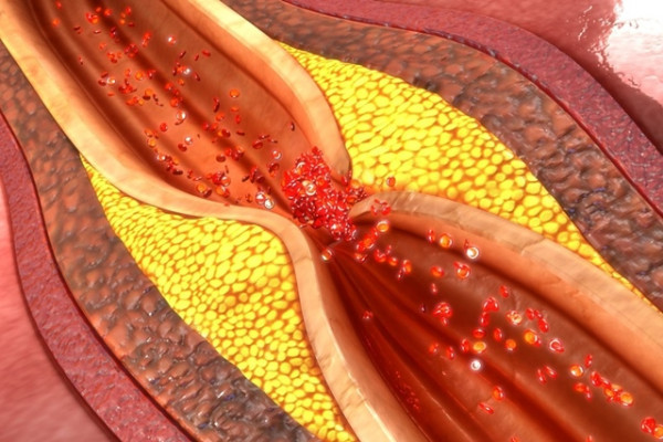 Chirurgie vasculară - Medpark Varicoza ateroscleroza vaselor de tromboflebită