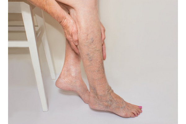 Amorțeală de degete și picioare cu varicoză