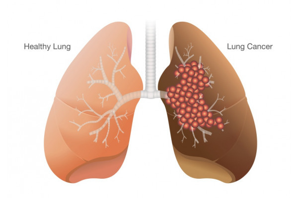 Cancerul pulmonar - Tratament si simptome timpurii, cancer la plamani